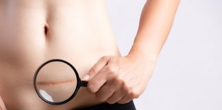 CARSKI REZ: Kako izgleda, koje su moguće komplikacije i kako teče oporavak CARSKI REZ Kako izgleda, koje su moguće komplikacije i kako teče oporavak