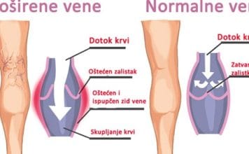 Proširene vene