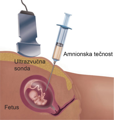 Svi TESTOVI U TRUDNOĆI koji otkrivaju genetičke nepravilnosti ploda