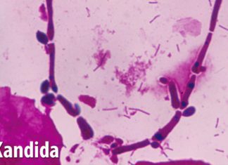 Jednostavan lijek protiv nabujale kandide