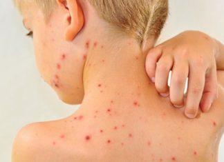 Sve o malim boginjama