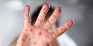 Epidemija se širi, povećan broj oboljelih od malih boginja!