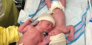 Nerazdvojni od rođenja: Blizanci tješili jedan drugog nakon poroda