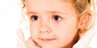 Još 4 slučaja malih boginja u Banjaluci