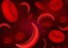 Matične ćelije iz pupčane vrpce: Šansa za liječenje srpaste anemije!