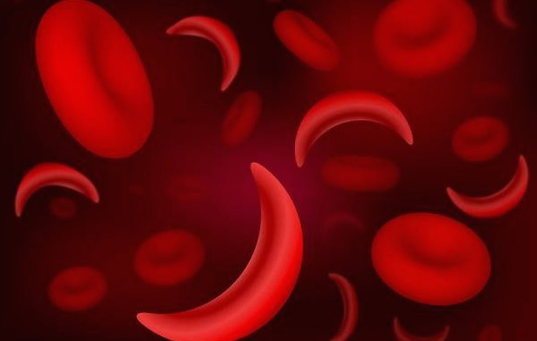 srpasta-anemija-kako je lijeciti