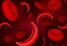 Matične ćelije iz pupčane vrpce: Šansa za liječenje srpaste anemije!