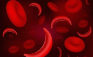 Matične ćelije iz pupčane vrpce: Šansa za liječenje srpaste anemije!